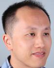 Before Hair Transplant&nbsp;Front